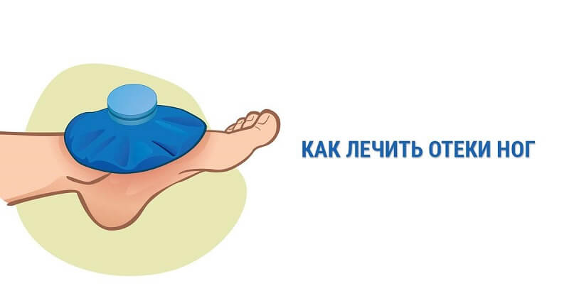 Отеки, причины и лечение данного недуга — Лайм