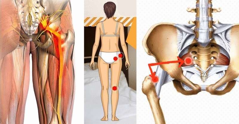 Два трюка которые разблокируют седалищного нерва