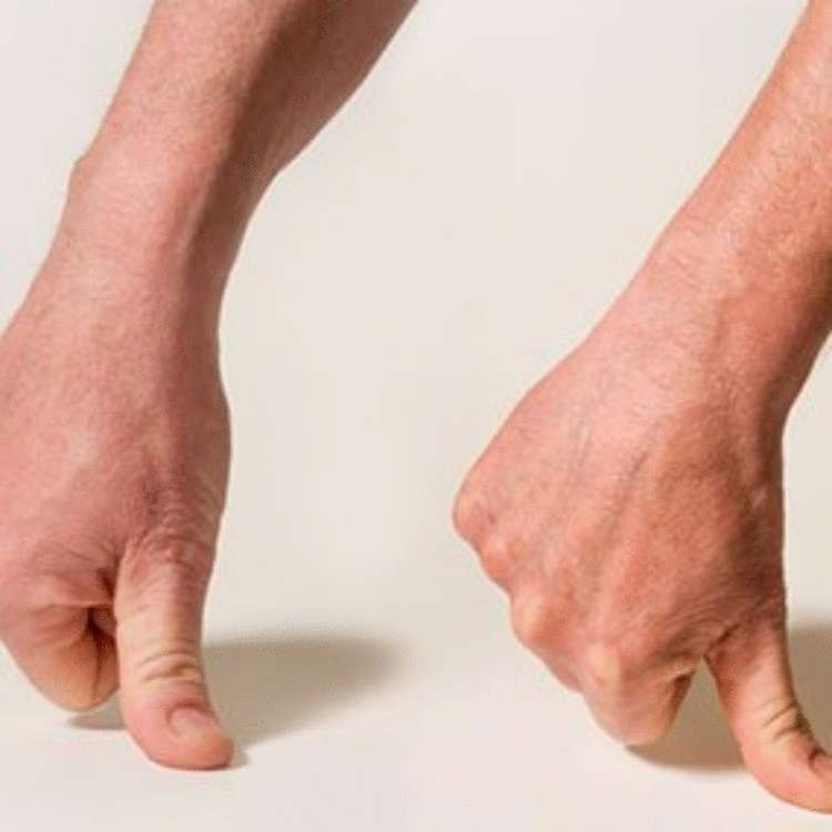 Руки при ревматоидном артрите фото
